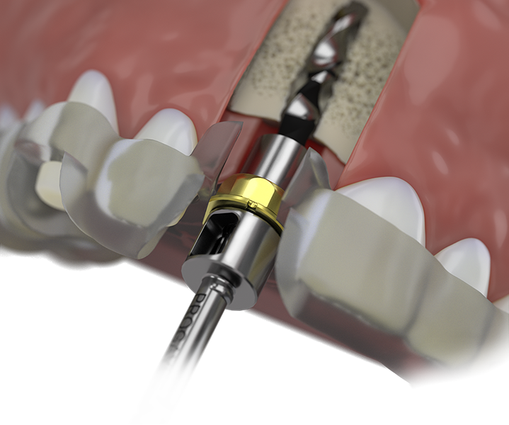 Pro Surgical System 引導式植體手術示意