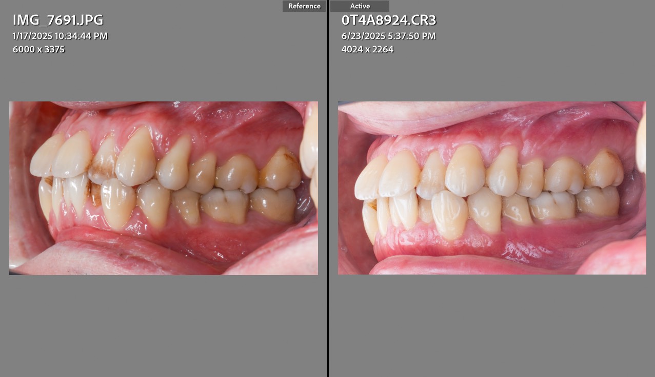 NovoMatrix 人工皮臨床案例，天母波士頓牙醫李瑜庭醫師提供的左側術前與追蹤對照影像