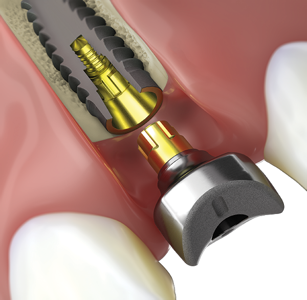 SmartShape conical cover