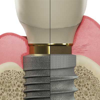 Tapered Pro Laser-Lok 表面比較圖