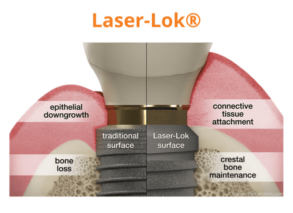 Laser-Lok 表面與傳統植體表面的軟組織附著及齒槽骨維持比較
