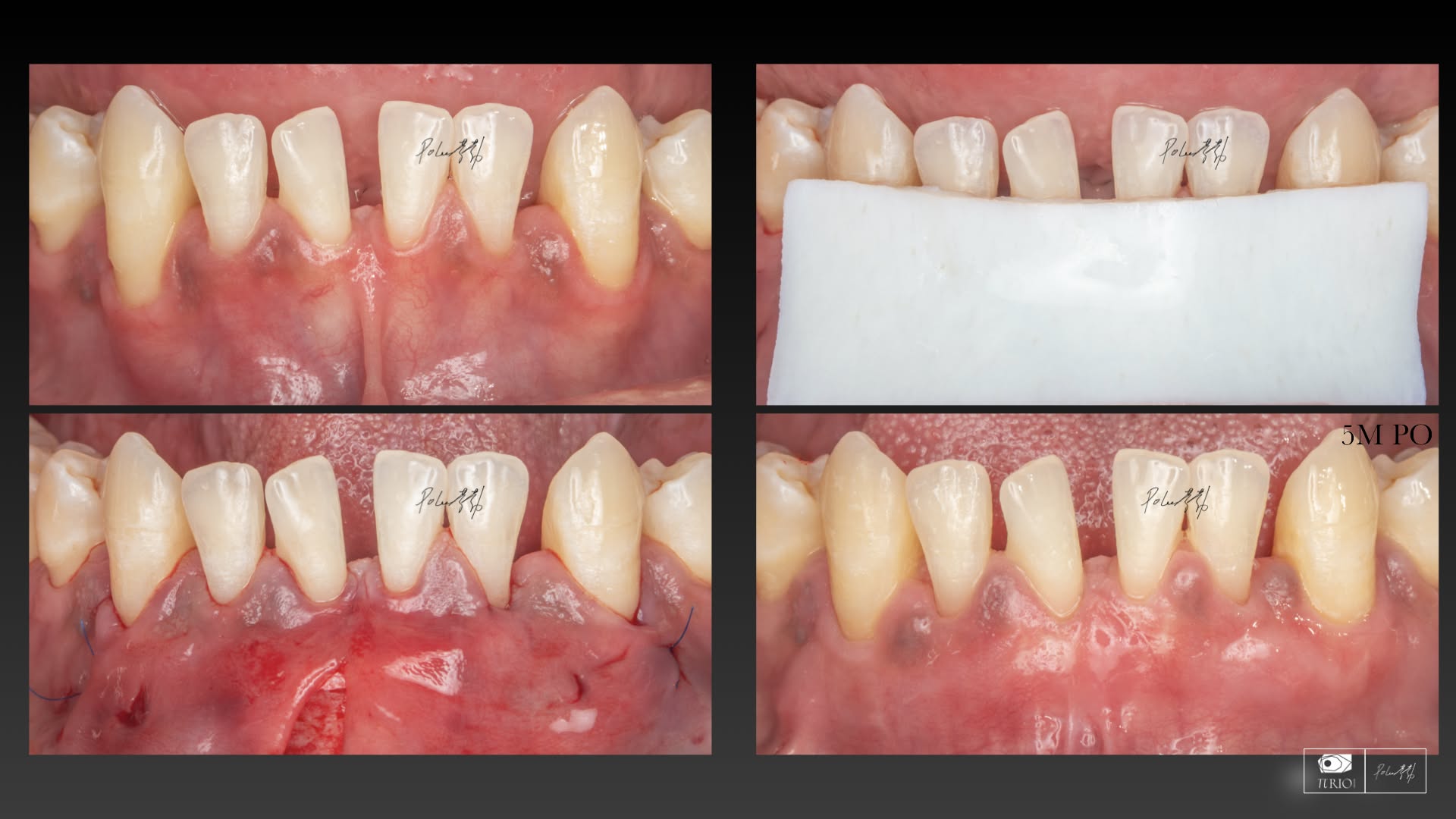 NovoMatrix 人工皮臨床案例，山石牙醫李勃醫師提供的 Root coverage Case 01 四階段影像與五個月追蹤