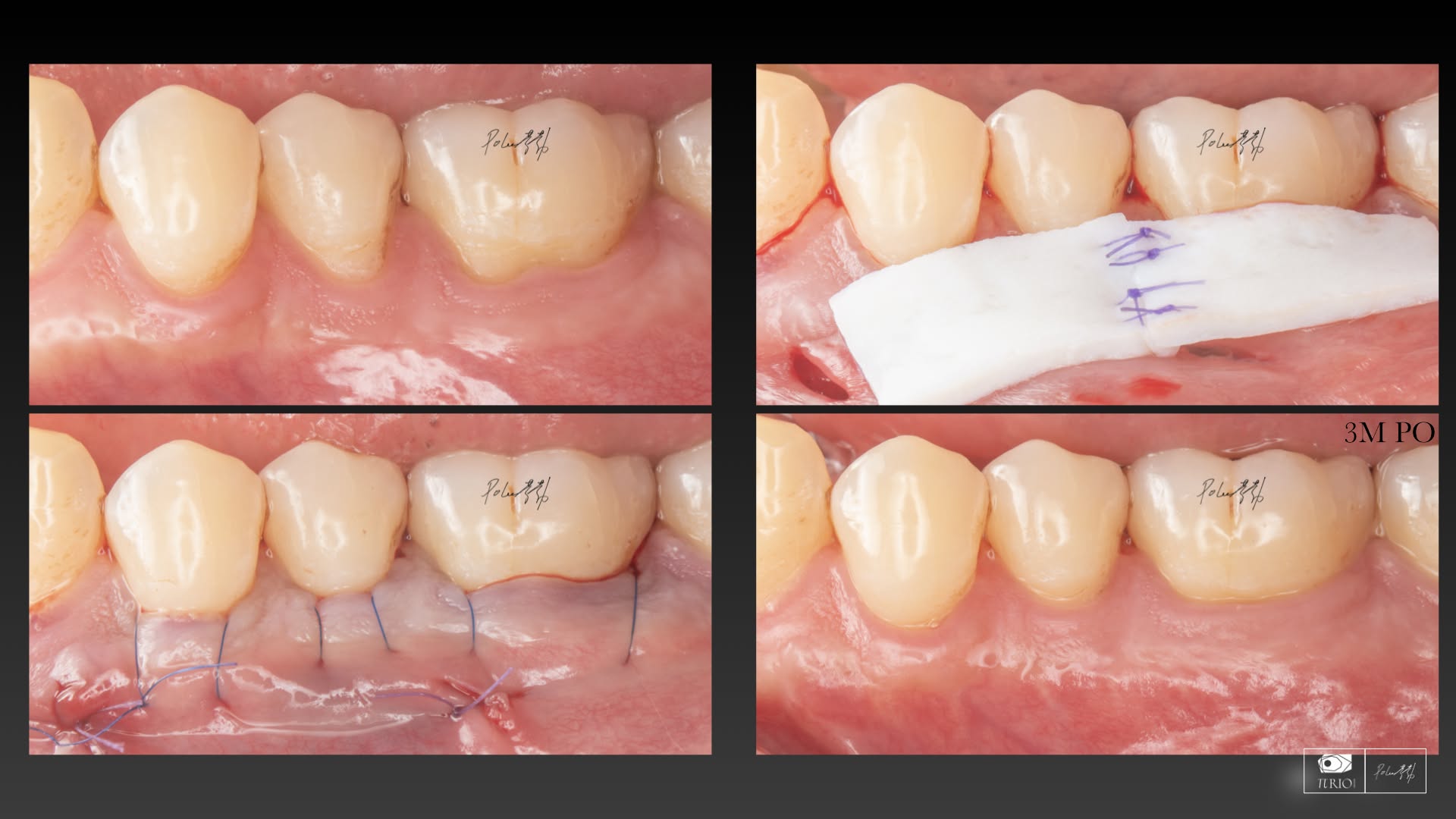 NovoMatrix 人工皮臨床案例，山石牙醫李勃醫師提供的 Root coverage Case 02 四階段影像與三個月追蹤