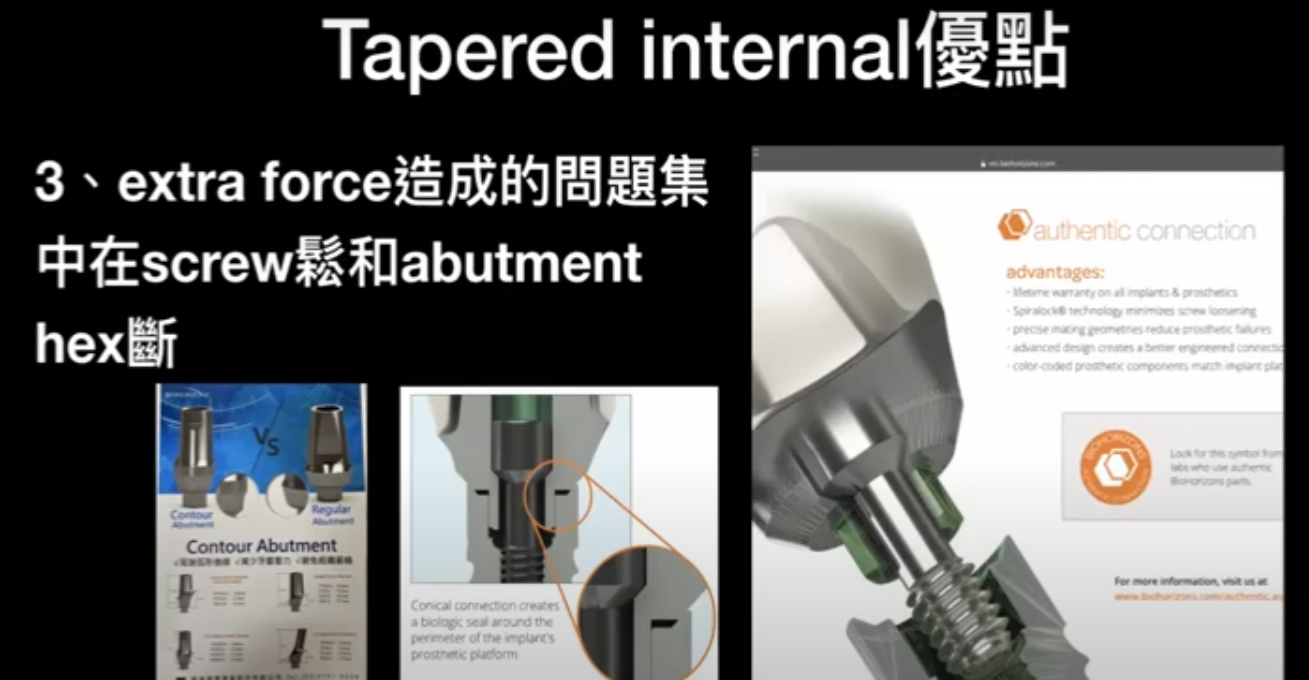 Tapered Internal 植體螺絲鬆動與支台齒頸部斷裂處理重點